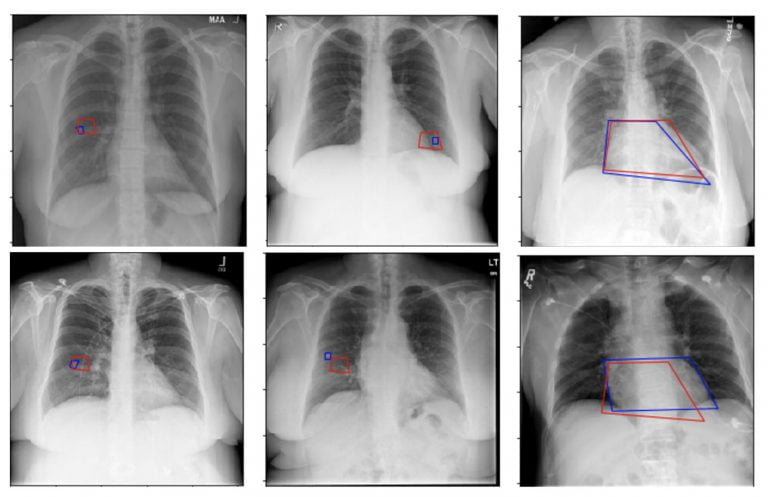 medical image analysis using ML